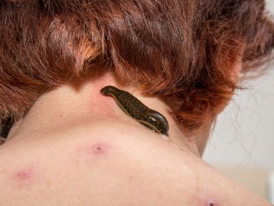 leech therapy in ayurveda treatment varanasi up